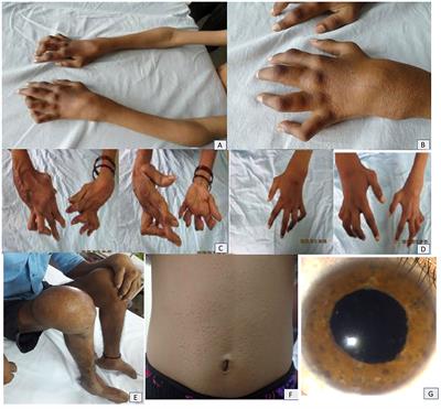 Blau syndrome: Lessons learned in a tertiary care centre at Chandigarh, North India